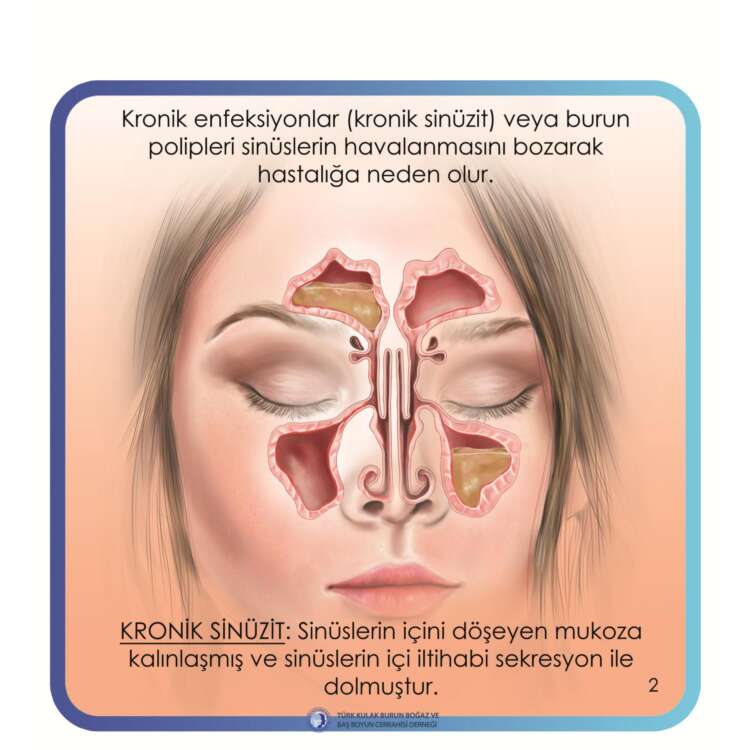 4. endoskopik sinüs cerrahisi (Endsocopic sinus surgery)_page-0003