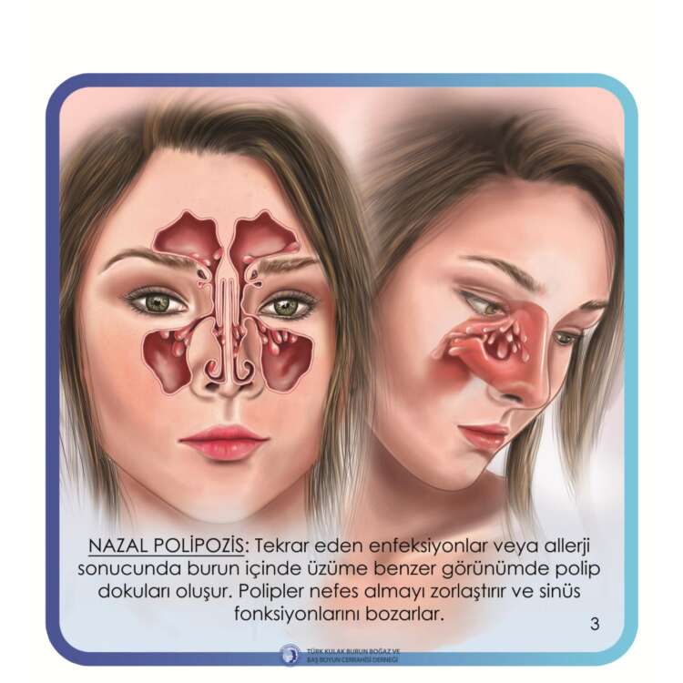 4. endoskopik sinüs cerrahisi (Endsocopic sinus surgery)_page-0004