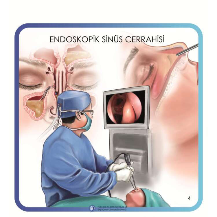 4. endoskopik sinüs cerrahisi (Endsocopic sinus surgery)_page-0005