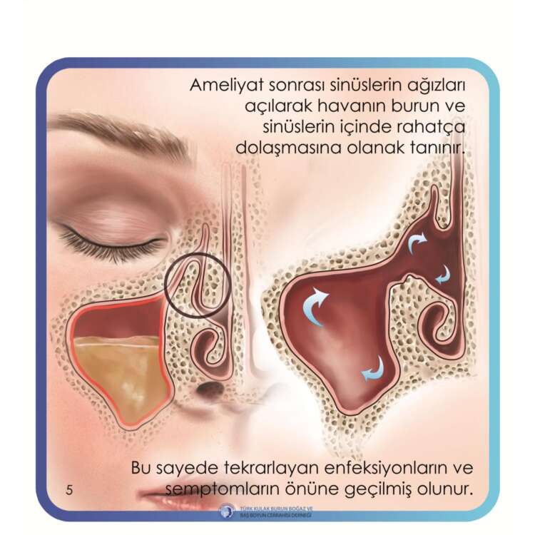 4. endoskopik sinüs cerrahisi (Endsocopic sinus surgery)_page-0006