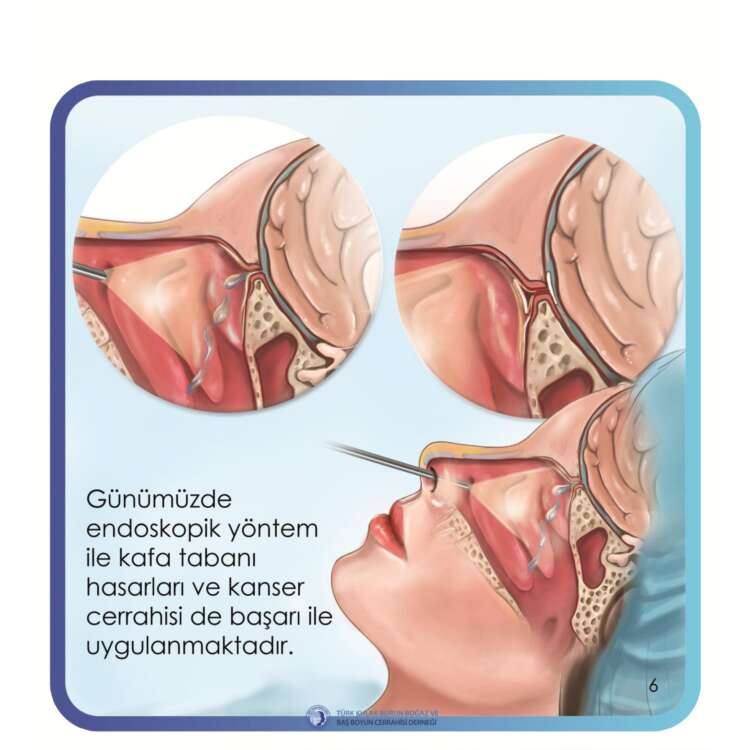 4. endoskopik sinüs cerrahisi (Endsocopic sinus surgery)_page-0007