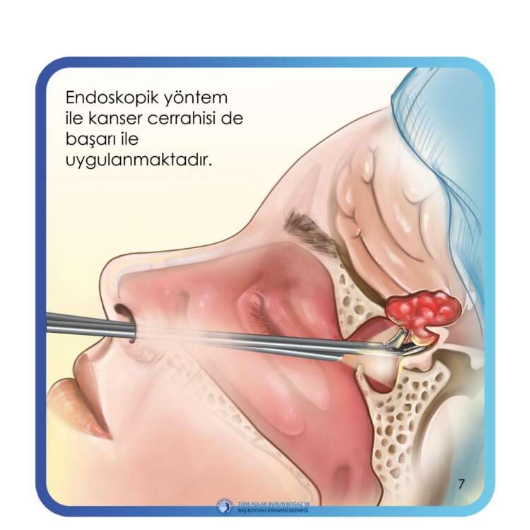 4. endoskopik sinüs cerrahisi (Endsocopic sinus surgery)_page-0008