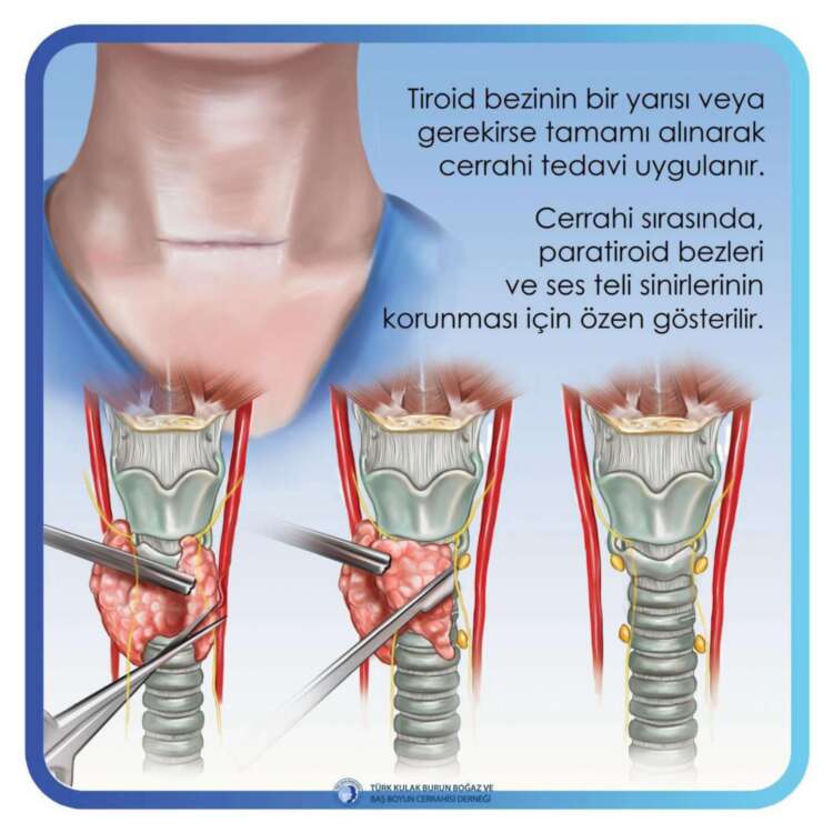 5. tiroid cerrahisi (Thyroid Surgery)_page-0005