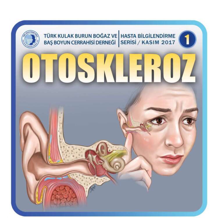 7. Otoskleroz (Otosclerosis)_page-0002