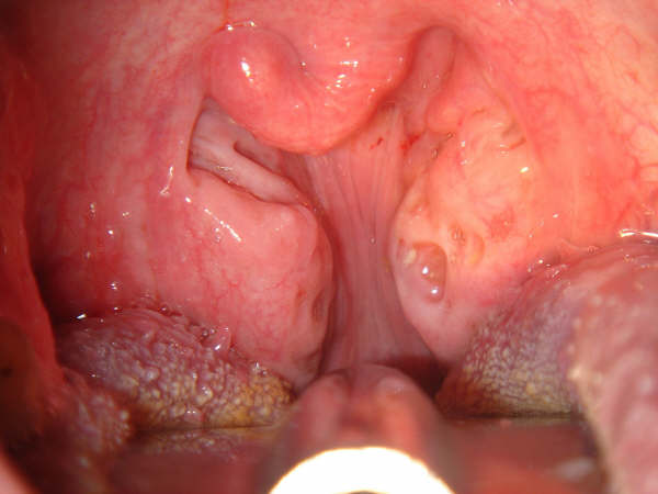 Tonsillectomy Adenoidectomy Tube